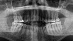 2D X-Ray Panoramic View